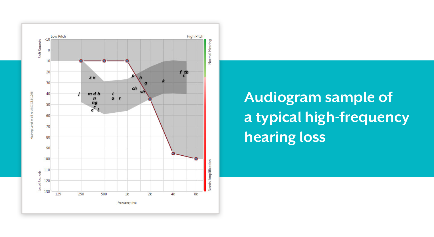 High-Frequency hearing loss audiogram sample.