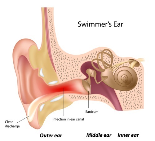 Swimmers ear