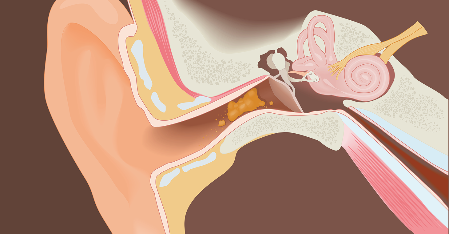 Earwax inside the ear. 