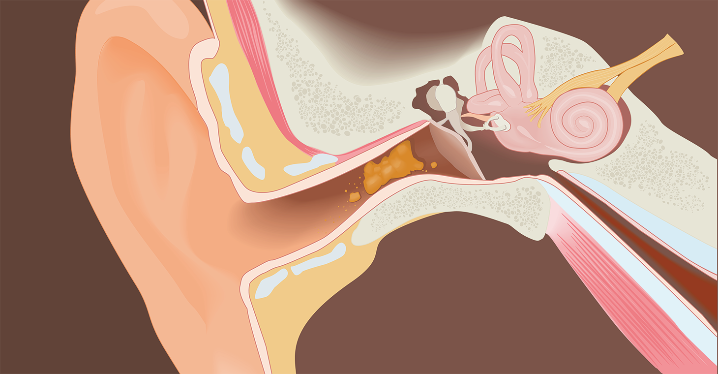 Earwax inside the ear.